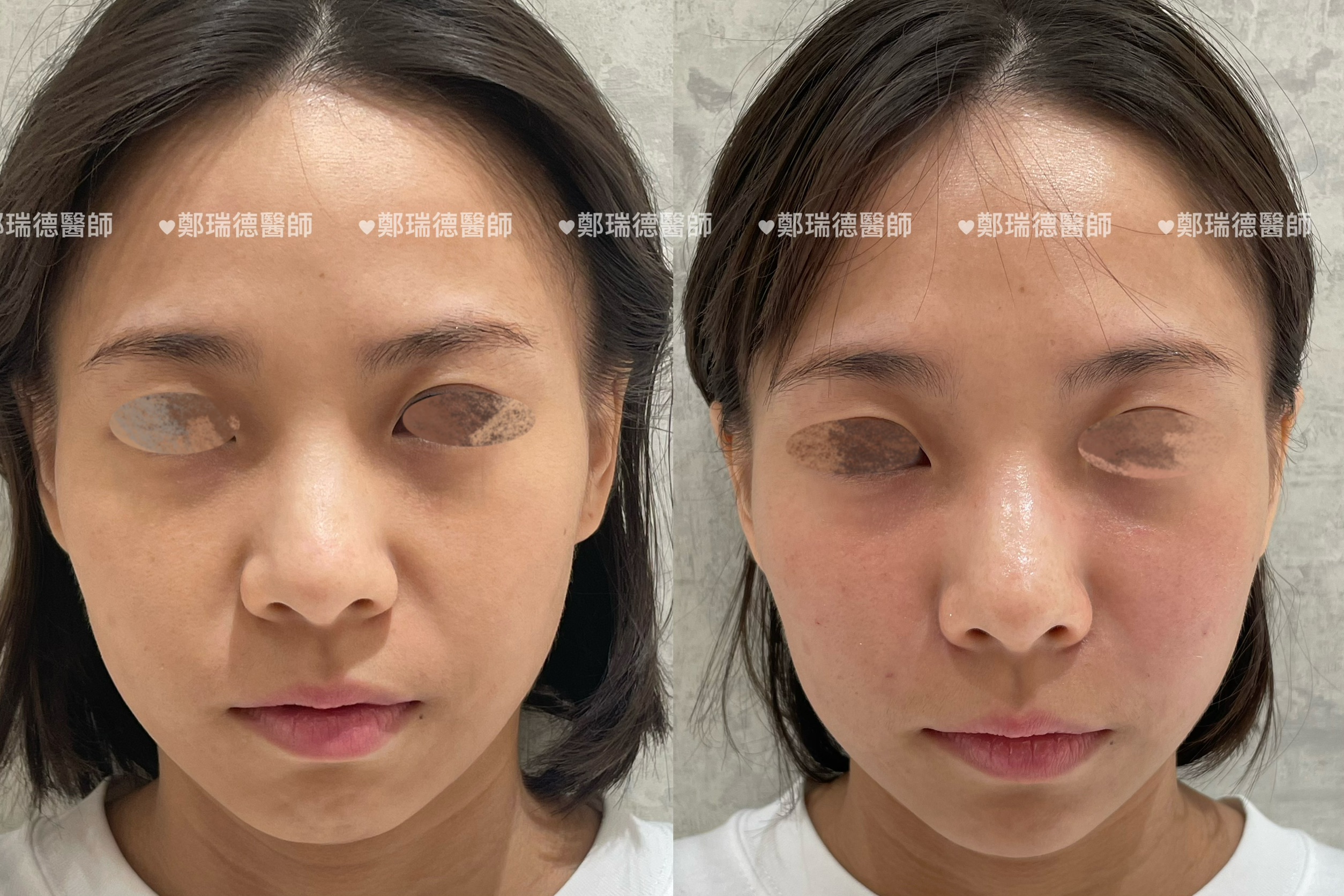 美學案例前後對比 — 圖片 1