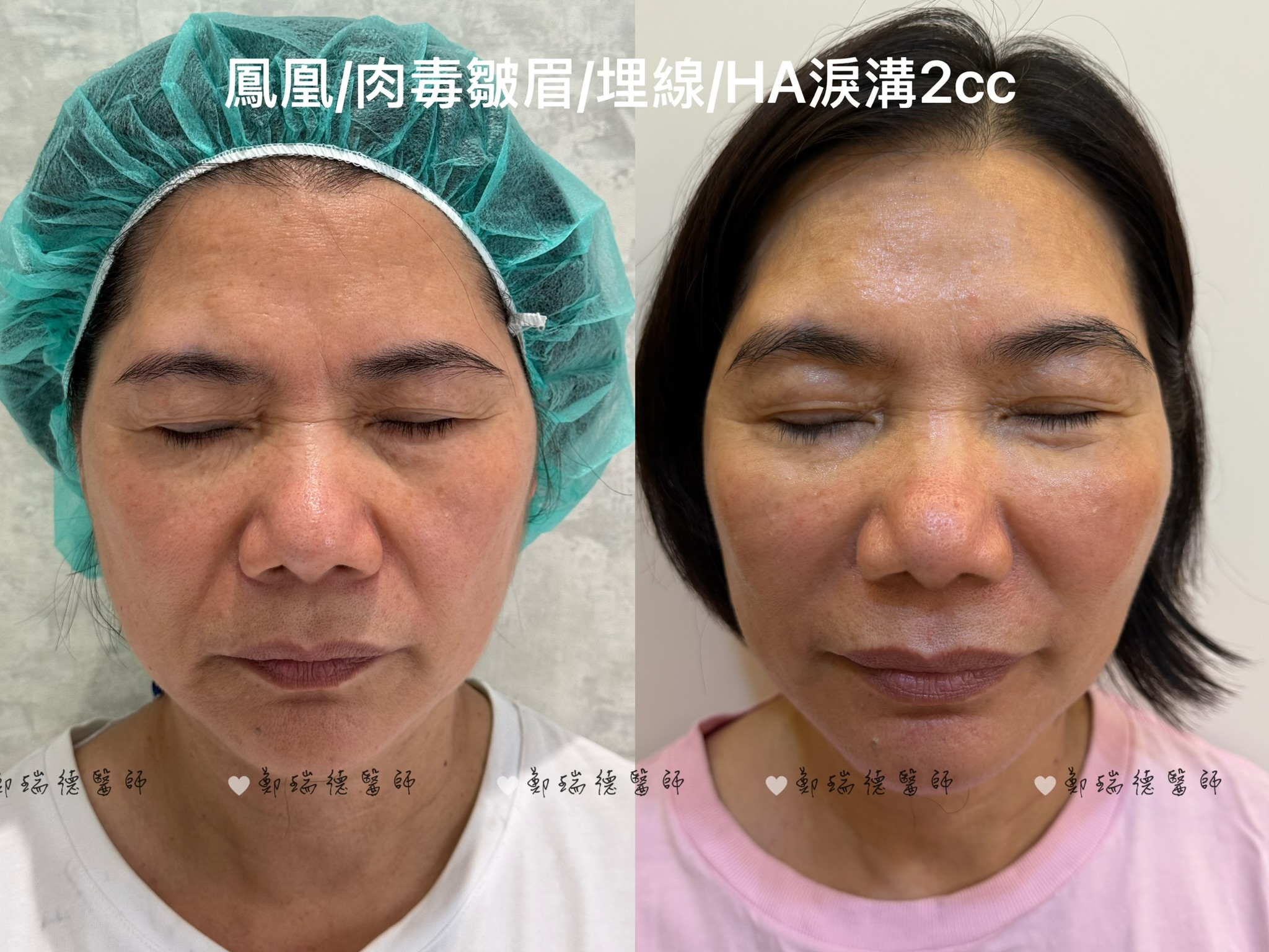 美學案例前後對比 — 圖片 3