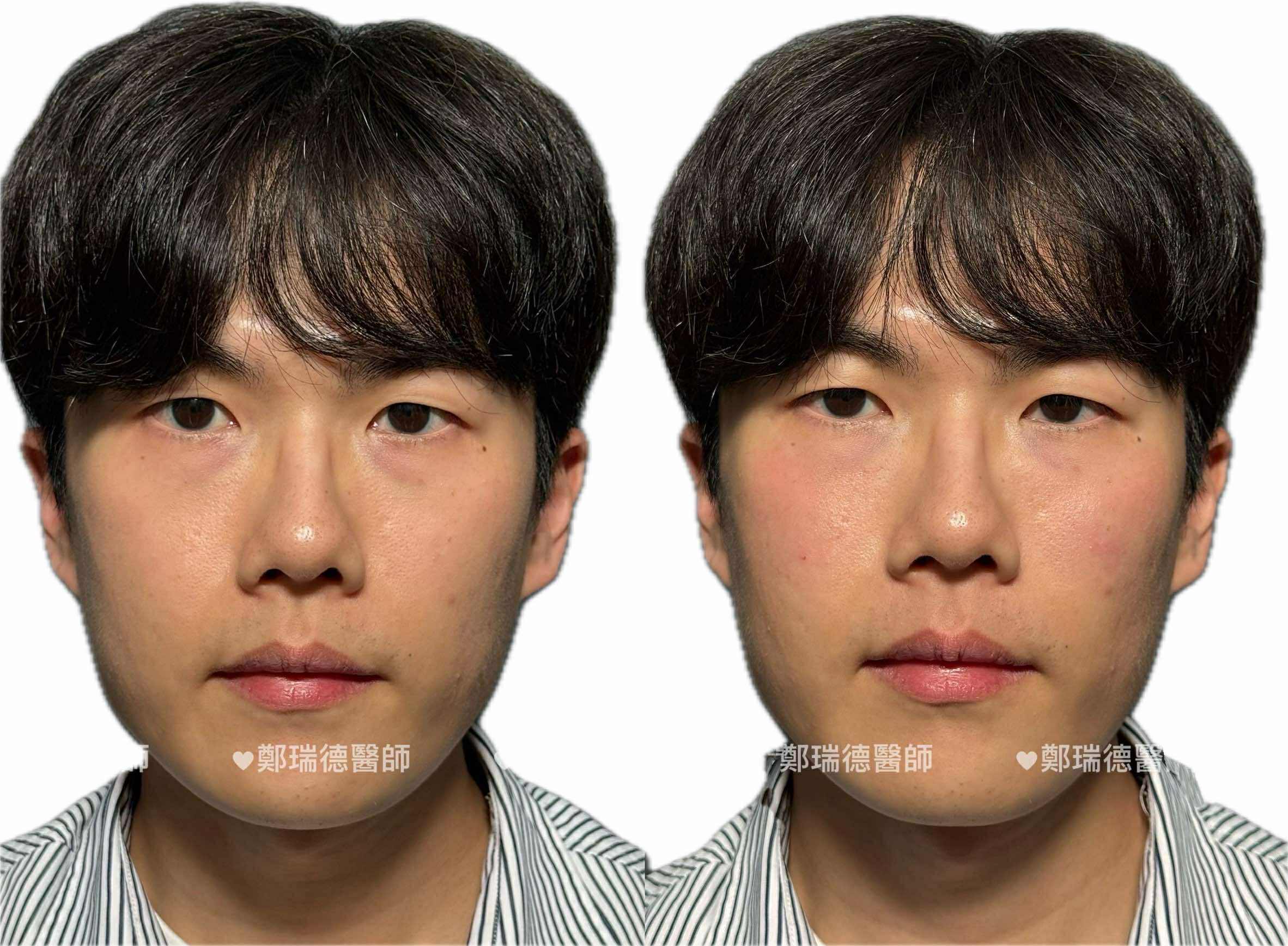 美學案例前後對比 — 圖片 8